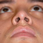 Rhinoplasty Before & After Patient #1570