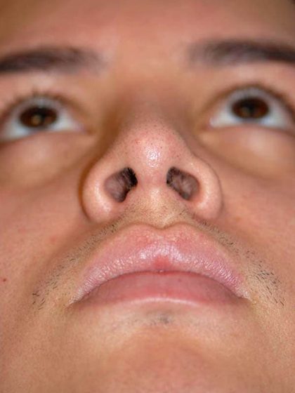 Rhinoplasty Before & After Patient #1570