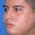 Rhinoplasty Before & After Patient #1570