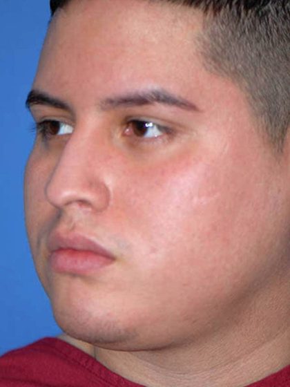 Rhinoplasty Before & After Patient #1570