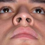 Rhinoplasty Before & After Patient #1570