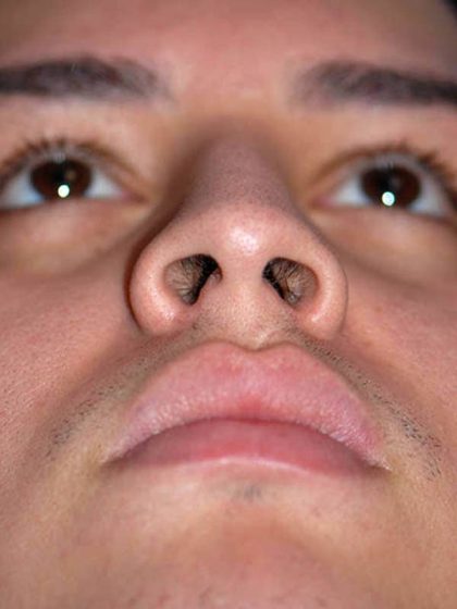 Rhinoplasty Before & After Patient #1570