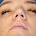 Rhinoplasty Before & After Patient #1569