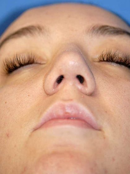 Rhinoplasty Before & After Patient #1569