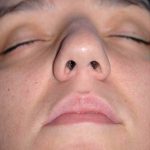 Rhinoplasty Before & After Patient #1569