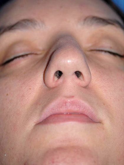 Rhinoplasty Before & After Patient #1569