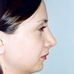 Rhinoplasty Before & After Patient #1568
