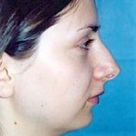 Rhinoplasty Before & After Patient #1568