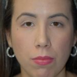 Rhinoplasty Before & After Patient #1567
