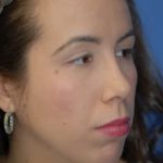 Rhinoplasty Before & After Patient #1567
