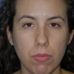 Rhinoplasty Before & After Patient #1567