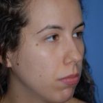 Rhinoplasty Before & After Patient #1567