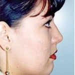 Rhinoplasty Before & After Patient #1566
