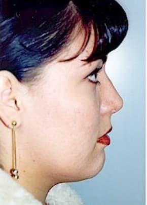 Rhinoplasty Before & After Patient #1566