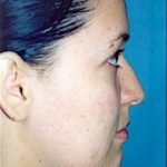Rhinoplasty Before & After Patient #1566