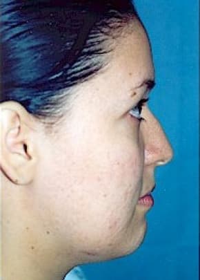 Rhinoplasty Before & After Patient #1566