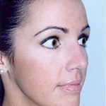 Rhinoplasty Before & After Patient #1565