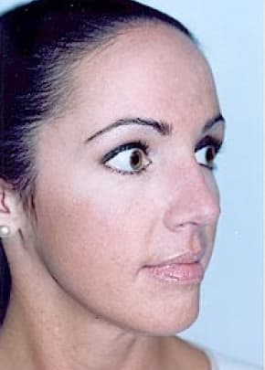 Rhinoplasty Before & After Patient #1565
