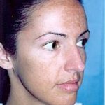Rhinoplasty Before & After Patient #1565