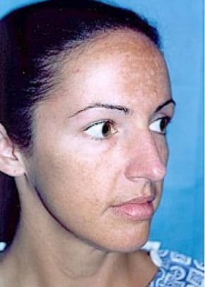 Rhinoplasty Before & After Patient #1565