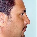 Rhinoplasty Before & After Patient #1564