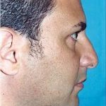 Rhinoplasty Before & After Patient #1564