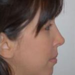 Rhinoplasty Before & After Patient #1563