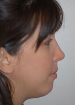 Rhinoplasty Before & After Patient #1563