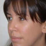 Rhinoplasty Before & After Patient #1563