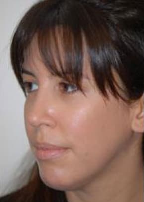 Rhinoplasty Before & After Patient #1563