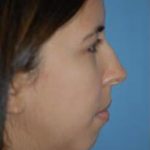 Rhinoplasty Before & After Patient #1563