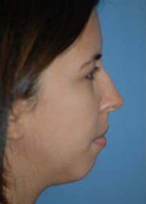 Rhinoplasty Before & After Patient #1563