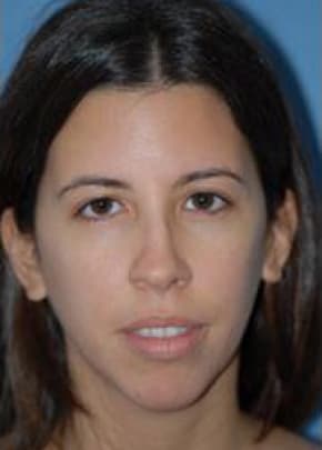 Rhinoplasty Before & After Patient #1563