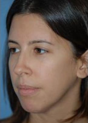 Rhinoplasty Before & After Patient #1563