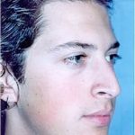 Rhinoplasty Before & After Patient #1562