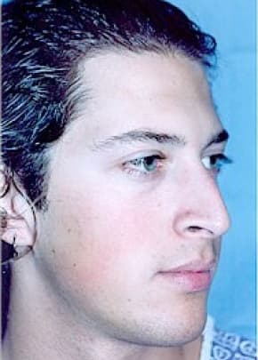 Rhinoplasty Before & After Patient #1562