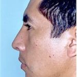 Rhinoplasty Before & After Patient #1561