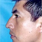 Rhinoplasty Before & After Patient #1561