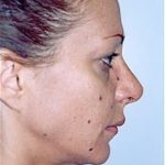 Rhinoplasty Before & After Patient #1560