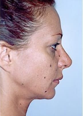 Rhinoplasty Before & After Patient #1560
