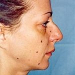 Rhinoplasty Before & After Patient #1560
