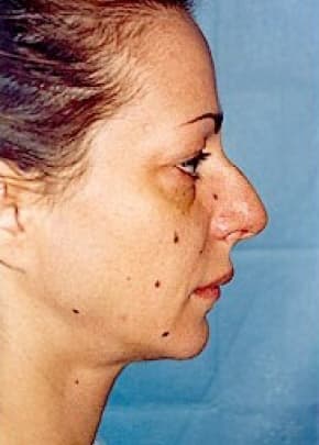 Rhinoplasty Before & After Patient #1560
