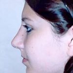 Rhinoplasty Before & After Patient #1559