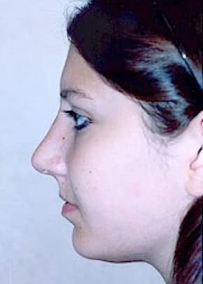 Rhinoplasty Before & After Patient #1559