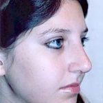 Rhinoplasty Before & After Patient #1559