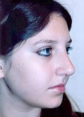 Rhinoplasty Before & After Patient #1559