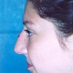 Rhinoplasty Before & After Patient #1559