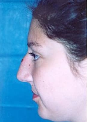 Rhinoplasty Before & After Patient #1559