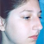 Rhinoplasty Before & After Patient #1559