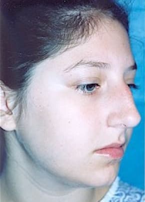 Rhinoplasty Before & After Patient #1559